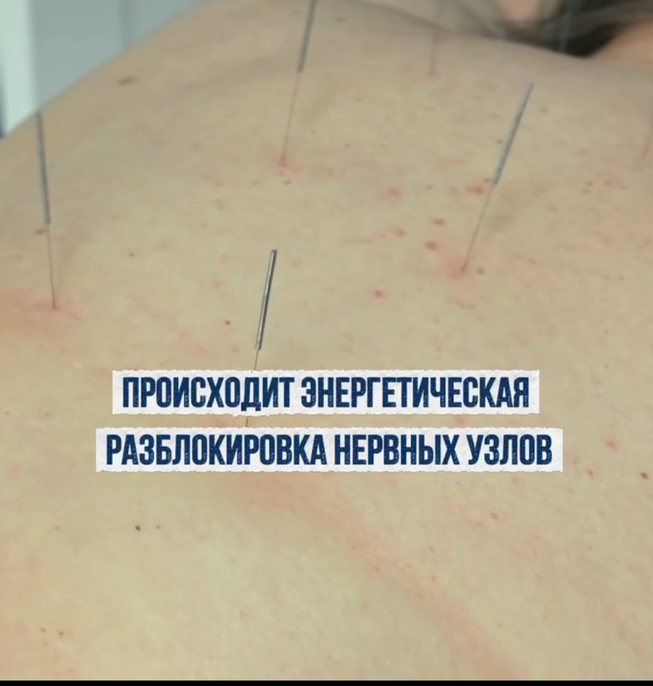 Акупунктурные иглы в деле!